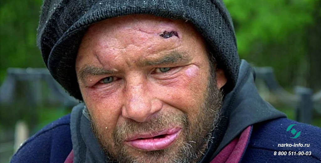 Лицо алкоголика