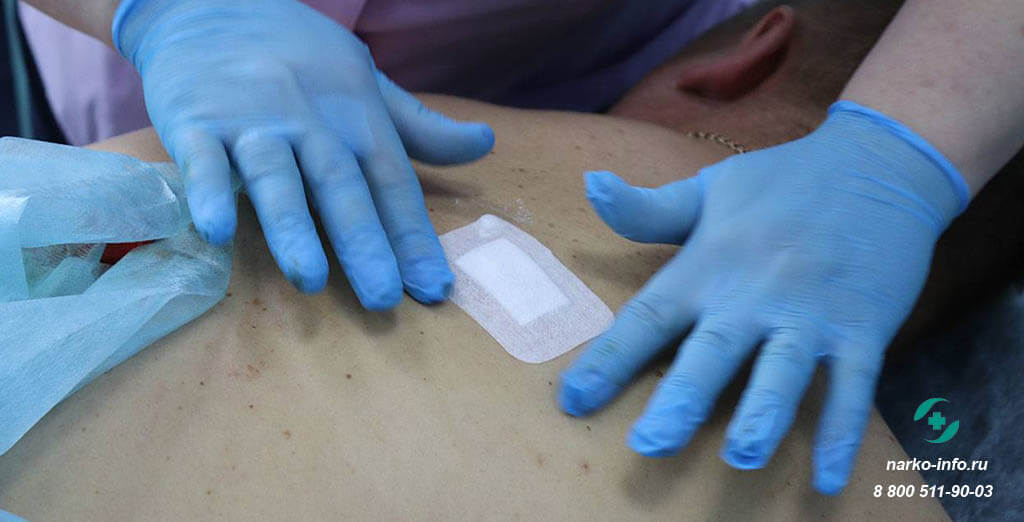 Вшивание ампулы