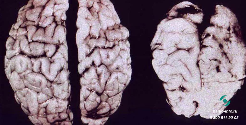 Влияние наркотина на мозг