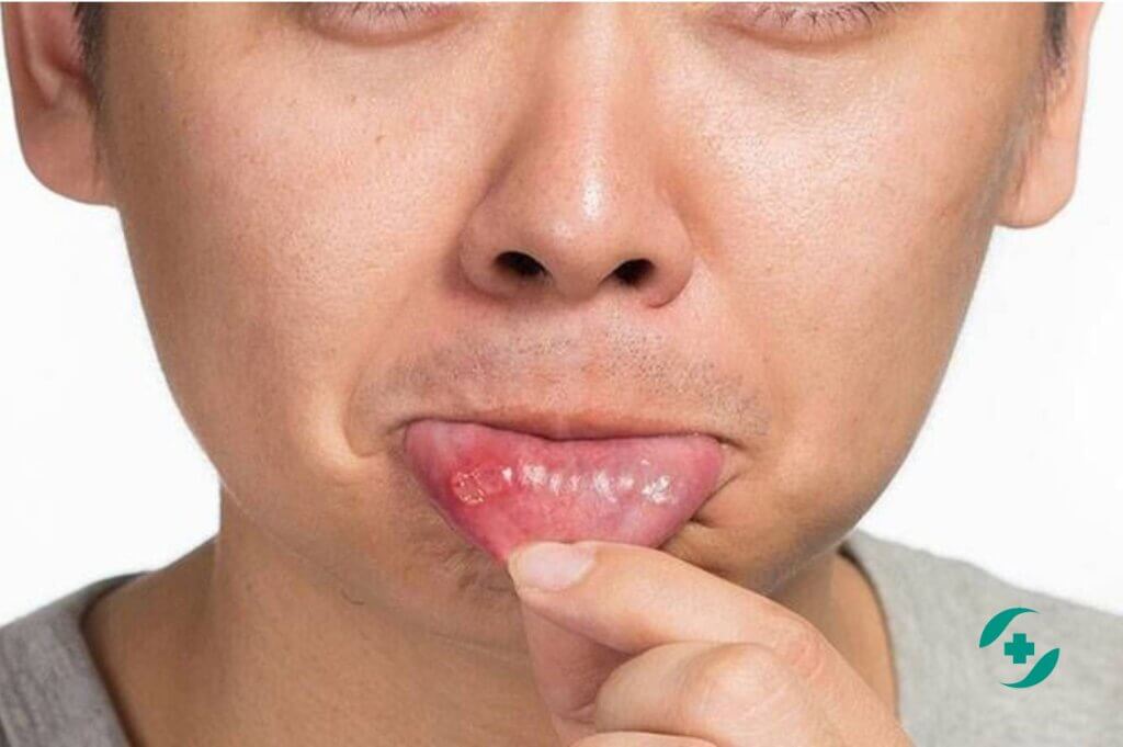 Прож 2 рливого рта. Афтозный стоматит Деформирующийся. Первичный сифилис в полости рта.